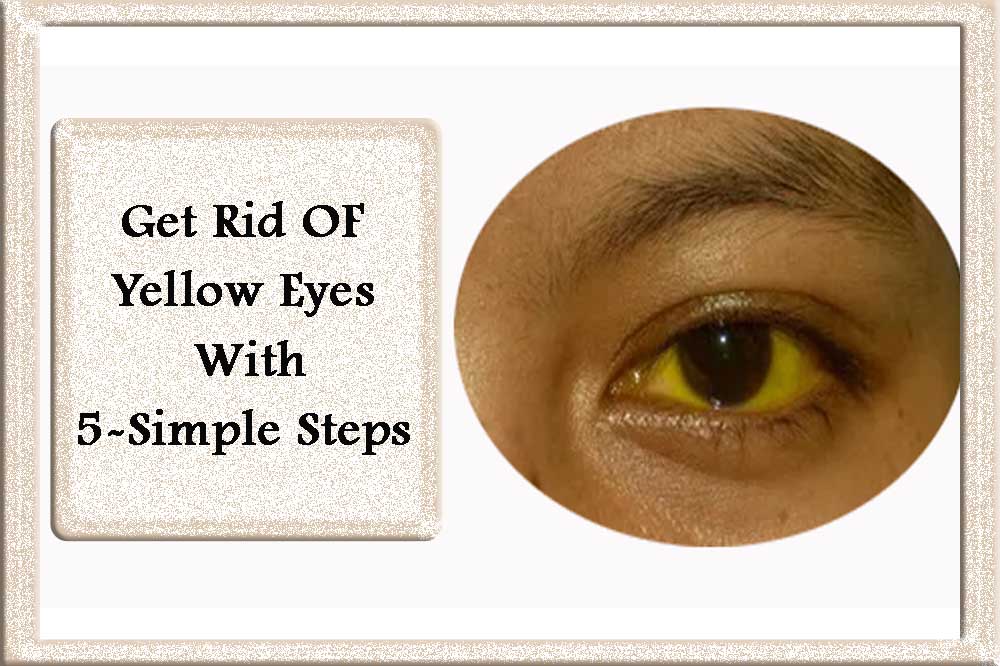 get-rid-of-yellow-eyes-treat-yellow-eyes-with-simple-steps-literary