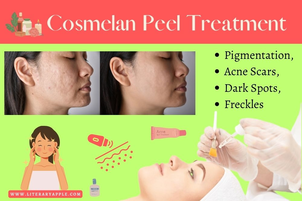 Cosmelan Peel Treatment