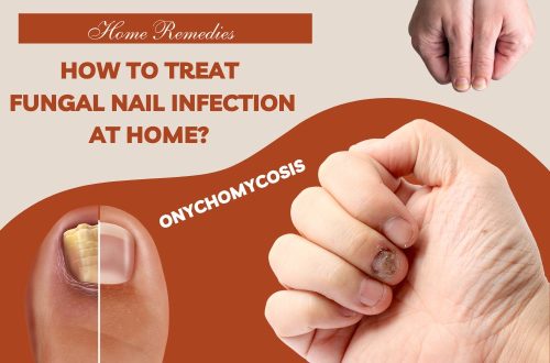 How to Treat Fungal Nail Infection at Home