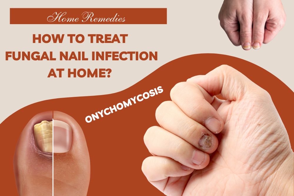 How To Treat Fungal Nail Infection At Home