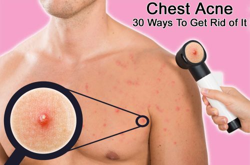 chest acne 30 ways to get rid of it