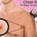 chest acne 30 ways to get rid of it